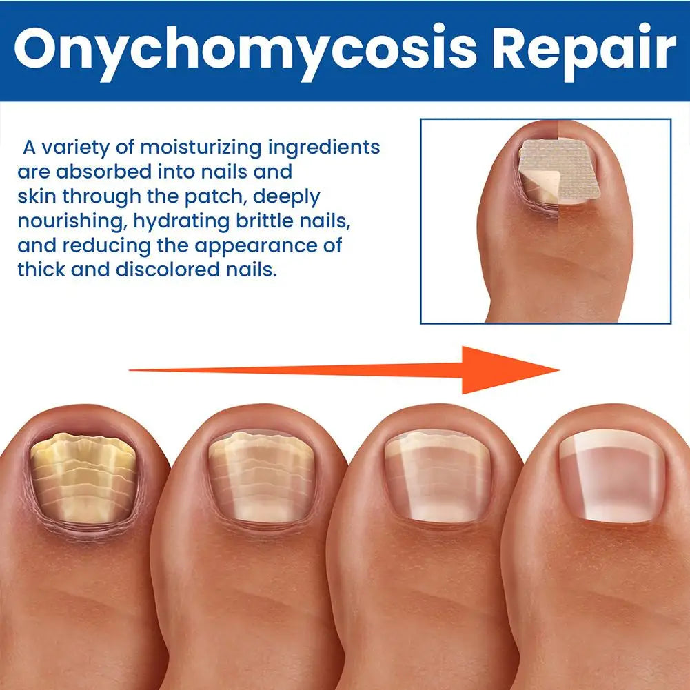 HealthyNail™ Fungal Nail Restoration Patches - Restore Clear, Healthy Nails Discreetly