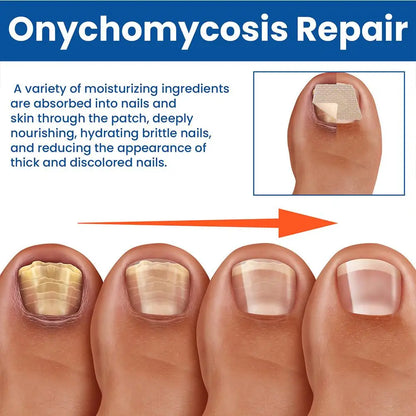 HealthyNail™ Fungal Nail Restoration Patches - Restore Clear, Healthy Nails Discreetly