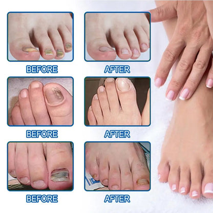 HealthyNail™ Fungal Nail Restoration Patches - Restore Clear, Healthy Nails Discreetly